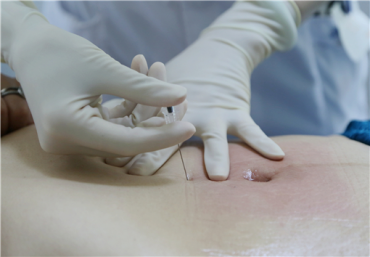 pga线是什么线【入围奖】《穴位埋线知多少，PGA线话你知》_https://www.jmylbn.com_新闻资讯_第4张