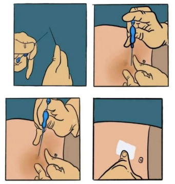 pga线是什么线【入围奖】《穴位埋线知多少，PGA线话你知》_https://www.jmylbn.com_新闻资讯_第3张