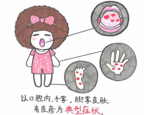 手足 口 病 食事