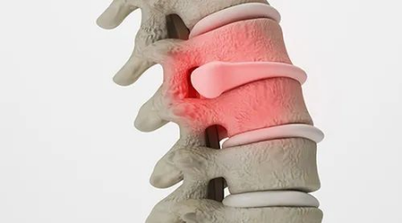 怎么使用腰椎牵引器腰椎病不动“刀”？了解一下这个“神器”_https://www.jmylbn.com_新闻资讯_第2张