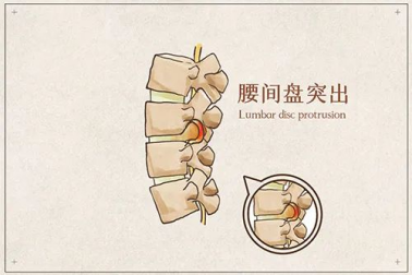 怎么使用腰椎牵引器腰椎病不动“刀”？了解一下这个“神器”_https://www.jmylbn.com_新闻资讯_第1张